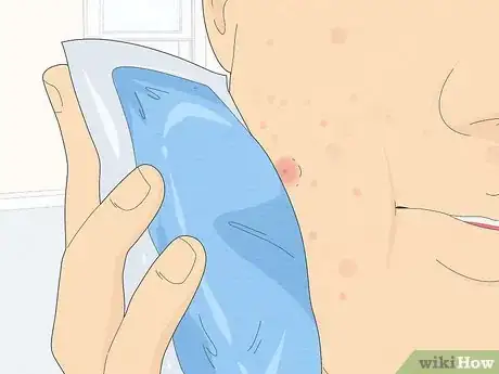 Image intitulée Get Rid of a Popped Pimple Overnight Step 11