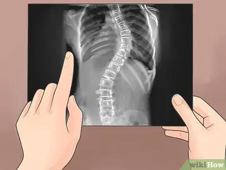 Image intitulée Treat Scoliosis Step 6