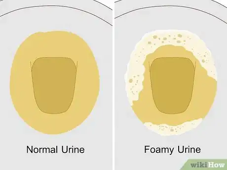 Image intitulée Reduce Foamy Urine Step 1