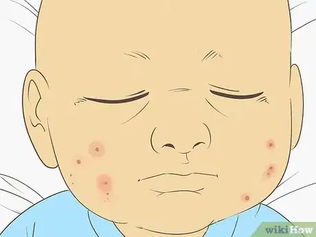 Image intitulée Know What to Expect on a Newborn's Skin Step 7