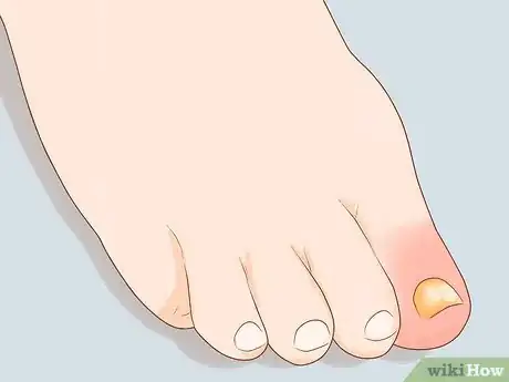 Image intitulée Treat a Swollen Toe Step 1
