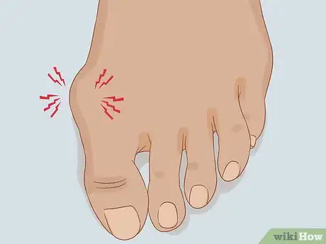 Image intitulée Treat a Swollen Toe Step 3