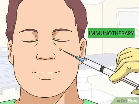 Image intitulée Remove Facial Warts Step 13