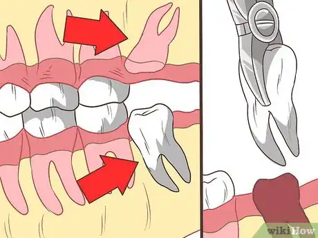 Image intitulée Straighten Your Teeth Without Braces Step 5
