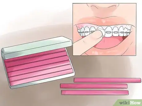 Image intitulée Eat With Braces Step 12