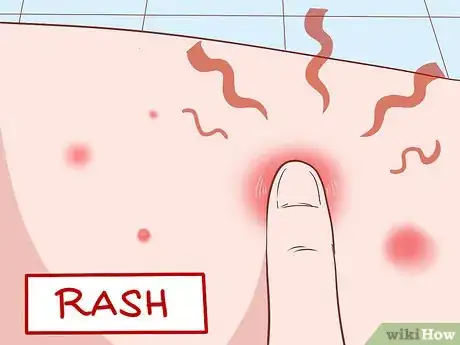 Image intitulée Identify Symptoms of MRSA Step 4