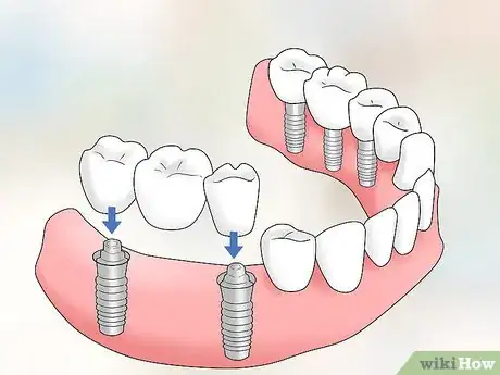 Image intitulée Keep Bottom Dentures in Place Step 18