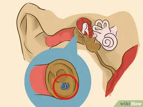 Image intitulée Drain Ear Fluid Step 17