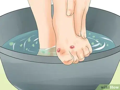 Image intitulée Make a Huge Blister Heal Step 14