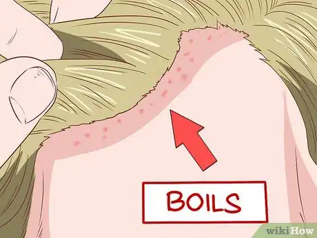 Image intitulée Identify Symptoms of MRSA Step 6