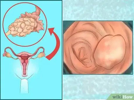 Image intitulée Know If Menstrual Periods Have Stopped Step 3