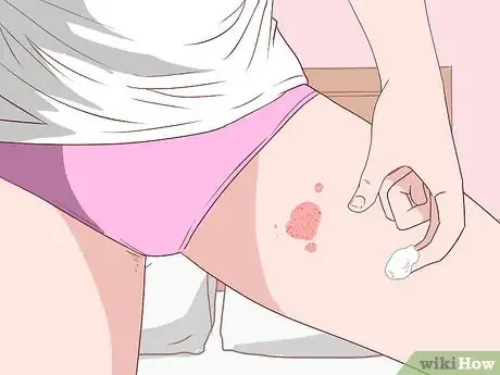 Image intitulée Treat Jock Itch With Sudocrem Step 10
