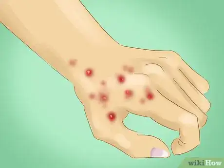 Image intitulée Avoid Catching Scabies Step 8