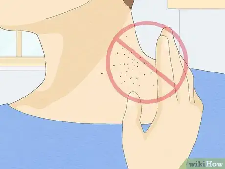 Image intitulée Identify Warts Step 16