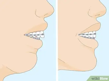 Image intitulée Fix an Overbite Step 8