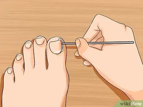 Image intitulée Relieve Ingrown Toe Nail Pain Step 17