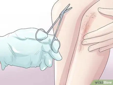 Image intitulée Know if You Have a Baker's Cyst Step 12