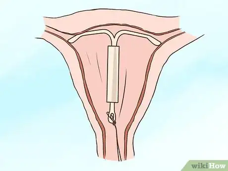 Image intitulée Get Birth Control Step 17