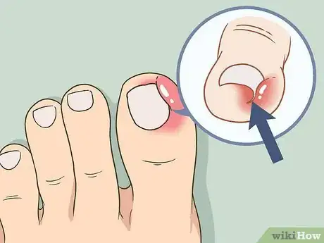 Image intitulée Soak an Ingrown Toenail Step 9