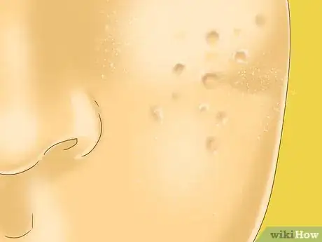 Image intitulée Hide Acne Scars Step 14