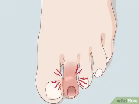 Image intitulée Treat a Swollen Toe Step 4