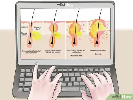 Image intitulée Treat an Infected Sebaceous Cyst Step 16