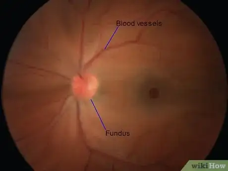 Image intitulée Use an Ophthalmoscope Step 14