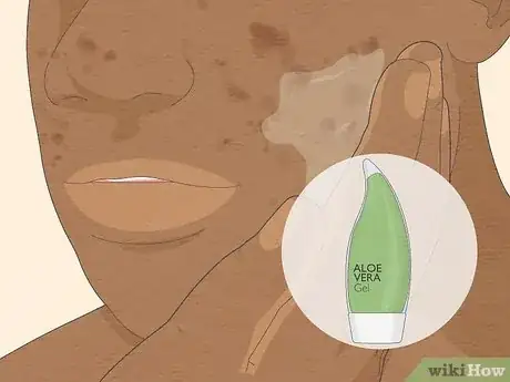 Image intitulée Get Rid of Cystic Acne Scars Step 3