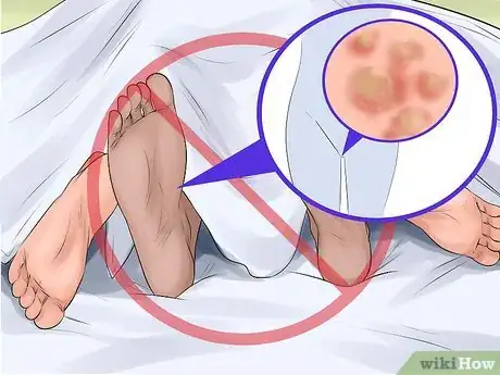 Image intitulée Prevent the Spread of Genital Warts Step 9