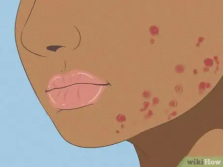 Image intitulée Get Rid of Acne if You Have Fair Skin Step 10