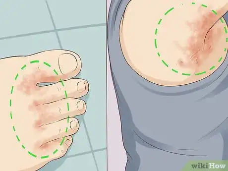 Image intitulée Treat a Yeast Infection on Your Skin Step 4.jpeg