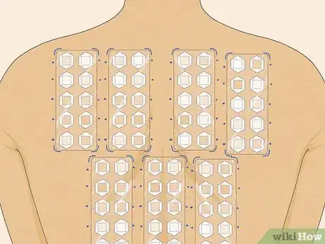 Image intitulée Read Allergy Skin Test Results Step 6