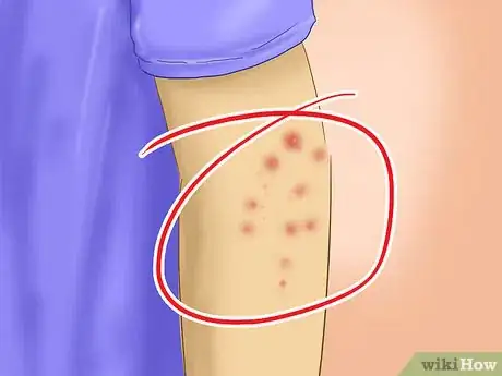 Image intitulée Avoid Catching Scabies Step 7