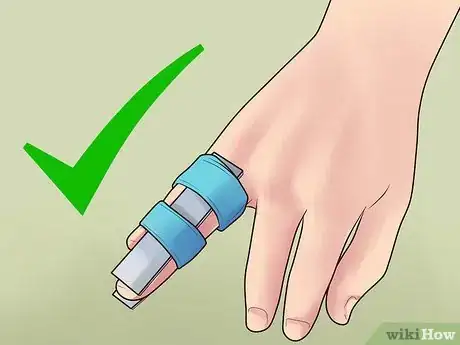 Image intitulée Splint a Finger Step 12