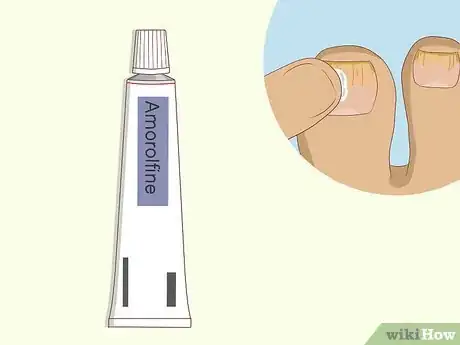 Image intitulée Cure Toenail Fungus with Vinegar Step 6