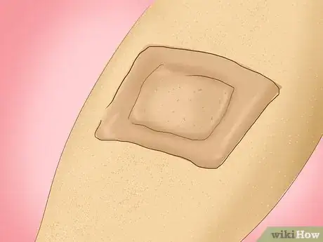 Image intitulée Treat a Staph Infection Step 10