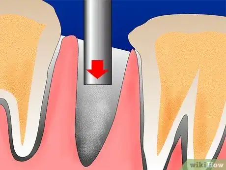 Image intitulée Get Rid of Gingivitis Step 4Bullet3