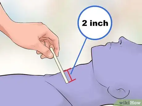 Image intitulée Perform a Tracheotomy Step 11