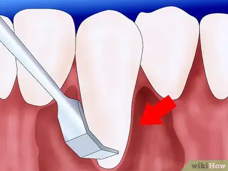 Image intitulée Get Rid of Gingivitis Step 4Bullet2