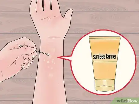 Image intitulée Get Rid of White Spots on the Skin Due to Sun Poisoning Step 4