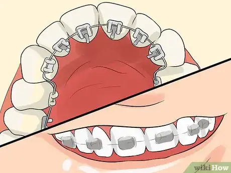 Image intitulée Prepare on the Day You Get Braces Step 2