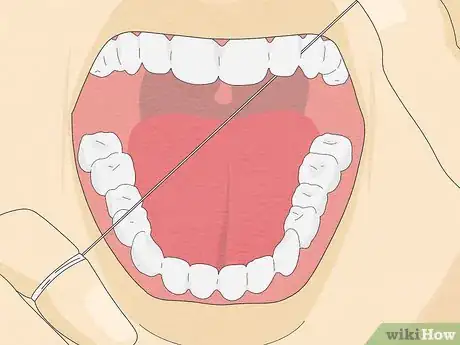 Image intitulée Fix Rotting Teeth Step 13