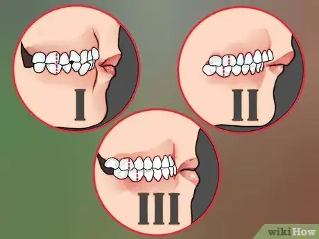 Image intitulée Diagnose an Overbite Step 3