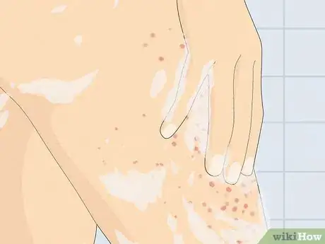 Image intitulée Treat a Face Rash After Waxing Step 10