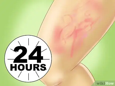 Image intitulée Recognize Hives (Urticaria) Step 4