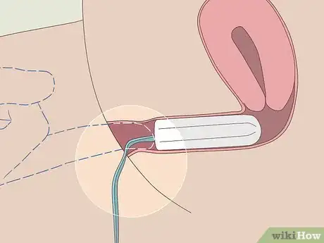 Image intitulée Insert a Tampon Without Applicator Step 9