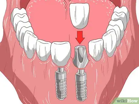 Image intitulée Straighten Your Teeth Without Braces Step 4