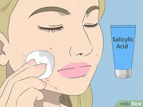 Image intitulée Get Rid of Acne if You Have Fair Skin Step 4