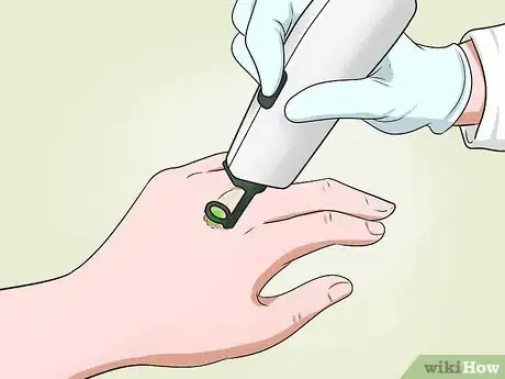 Image intitulée Get Rid of Warts on Hands Step 12