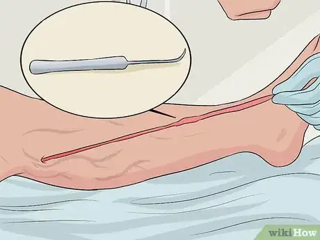 Image intitulée Get Rid of Varicose Veins Step 14